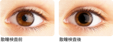 散瞳検査前後の比較